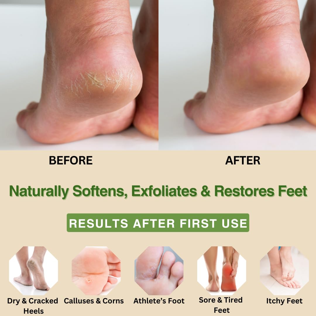 Peppermint, Rosemary, Eucalyptus & Tea Tree Oil Foot Cream for Dry Feet, Cracked Heels, Calluses, Athlete's Foot - Heel Repair Cream for Women & Men (8 oz)