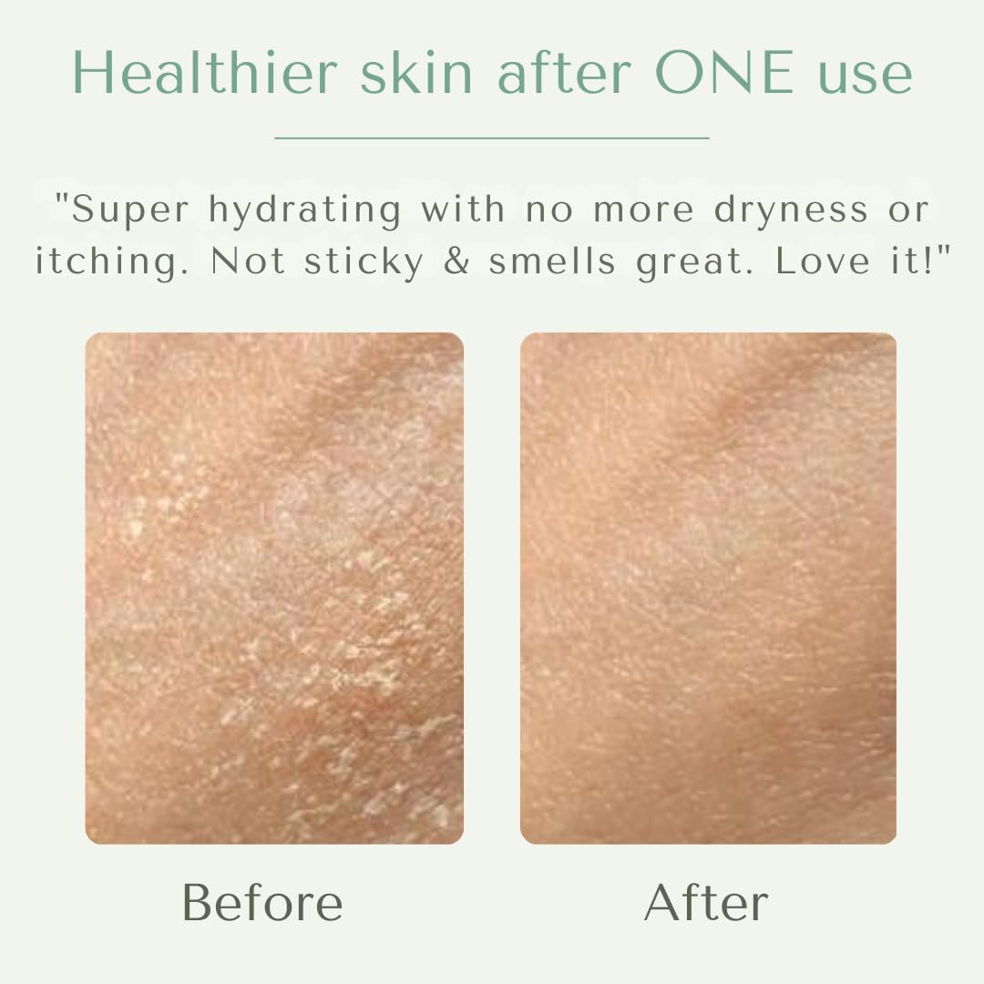 Yobee Body & Face Cream for Dry, Itchy Skin | Dermatologist Formulated | Probiotics, Honey, Turmeric, Vitamins B12 & E, Ceramides, Shea Butter | Fragrance Free | For Kids & Adults | Soothe Eczema
