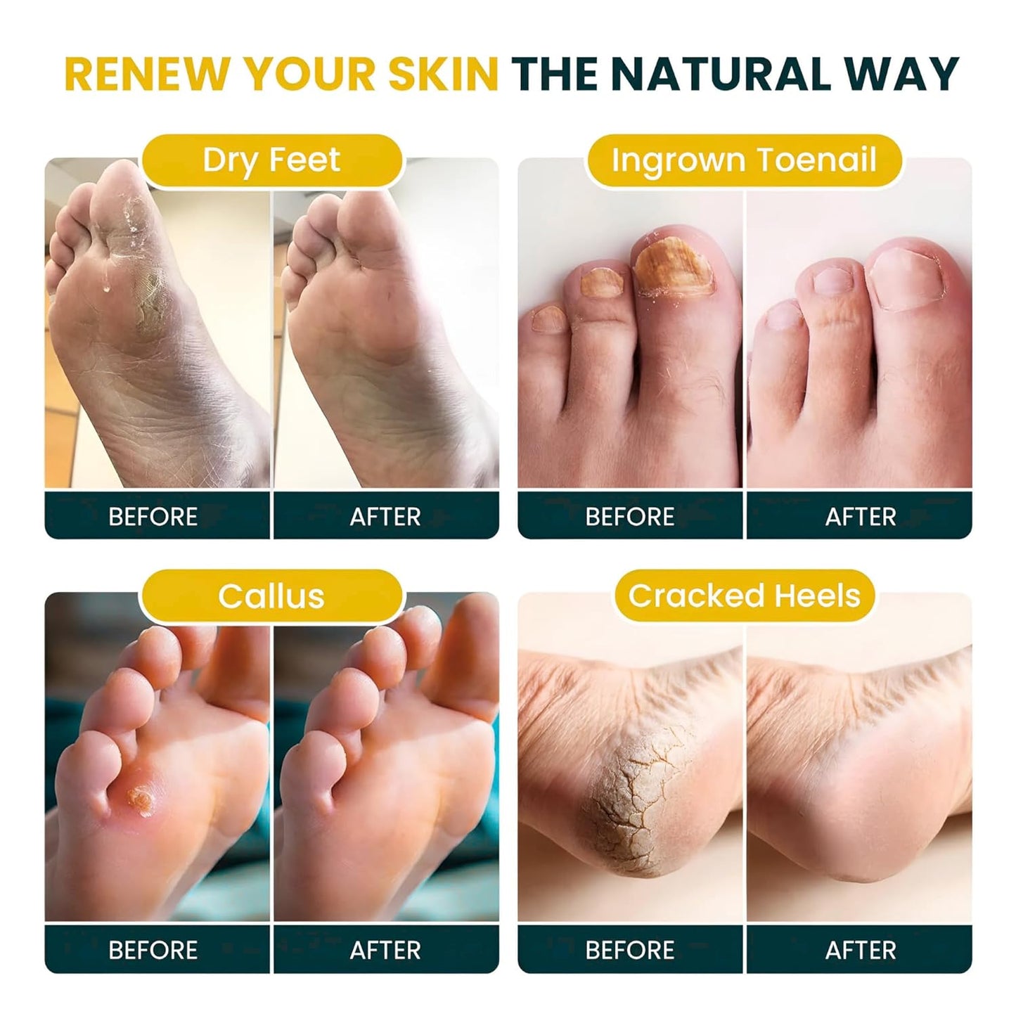 Citrus Detox Foot Soak with Epsom Salts – for Foot Callus, Damaged Toenail Appearance, Pedicure Spa, and Soothing Sore, Tired Feet – Made in USA – 16oz