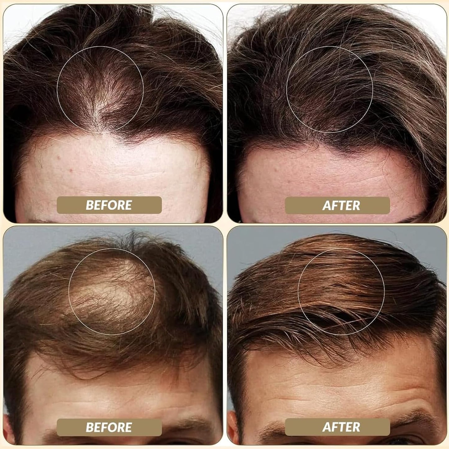 SOVONCARE Hair Fibers for Thinning Hair Medium Brown, Hair Building Fibers for Bald Spots Undetectable & Natural, Conceals Hair Loss Fill In Fine Hair Powder Hair Thicker Instantly for Women & Men 28g