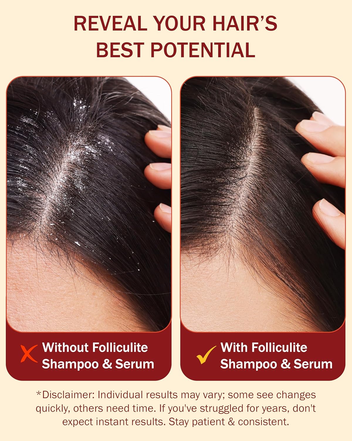 Folliculitis Treatment Shampoo & Serum with 3% BHA, Salicylic Acid, Tea Tree Oil & Chamomile Extracts - Anti Itch Shampoo for women & men with Flaky Scalp Treatment Acne, Made in USA by e70, 8 fl oz